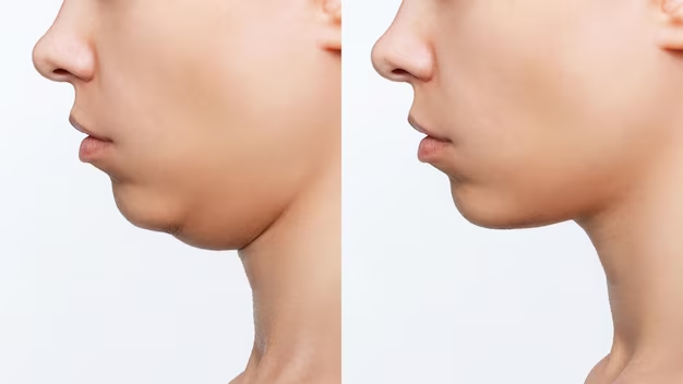 neck and chin sculpting
